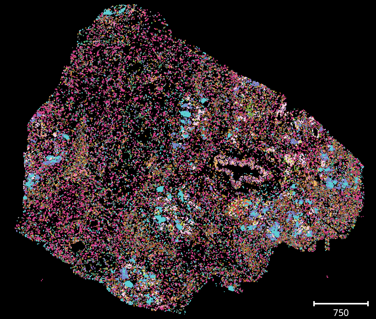 Transcriptionally defined morphological subtypes of pancreatic ductal adenocarcinoma