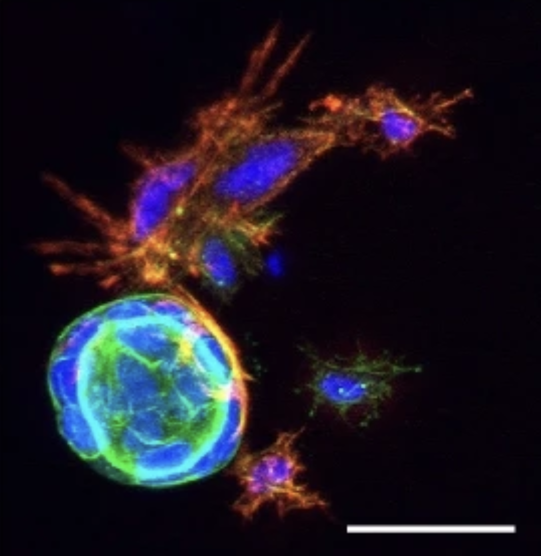 Patient-specific modeling of stroma-mediated chemoresistance of pancreatic cancer using a three-dimensional organoid-fibroblast co-culture system
