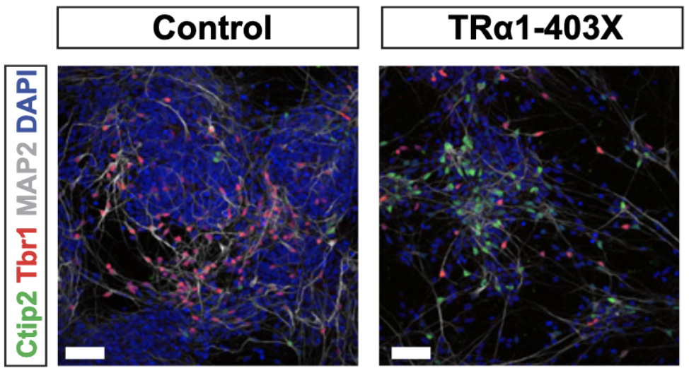 Mutations in thyroid hormone receptor α1 cause premature neurogenesis and progenitor cell depletion in human cortical development